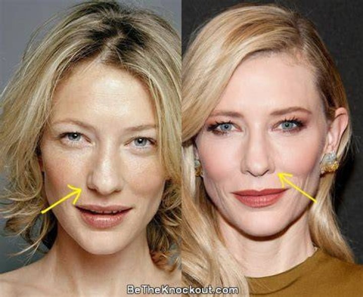 Cate Blanchett Facelift Plastic Surgery Before and After