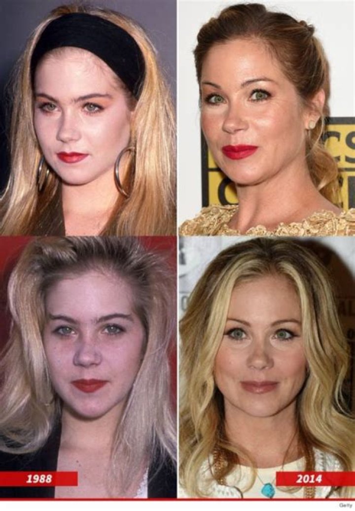 Christina Applegate Plastic Surgery Before and After