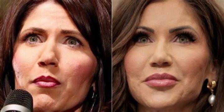  kristi noem plastic surgery